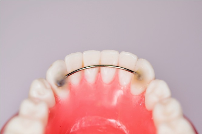 Fil de contention orthodontique