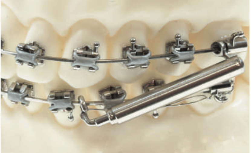 Système Leonus/Forsus orthodontique
