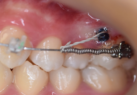 Mini-vis orthodontique en titane