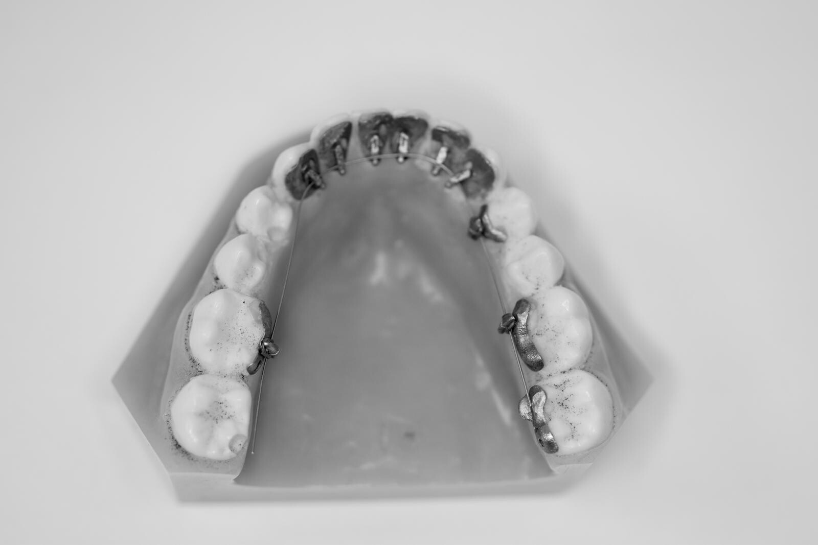 Brackets linguaux posés sur la face interne des dents